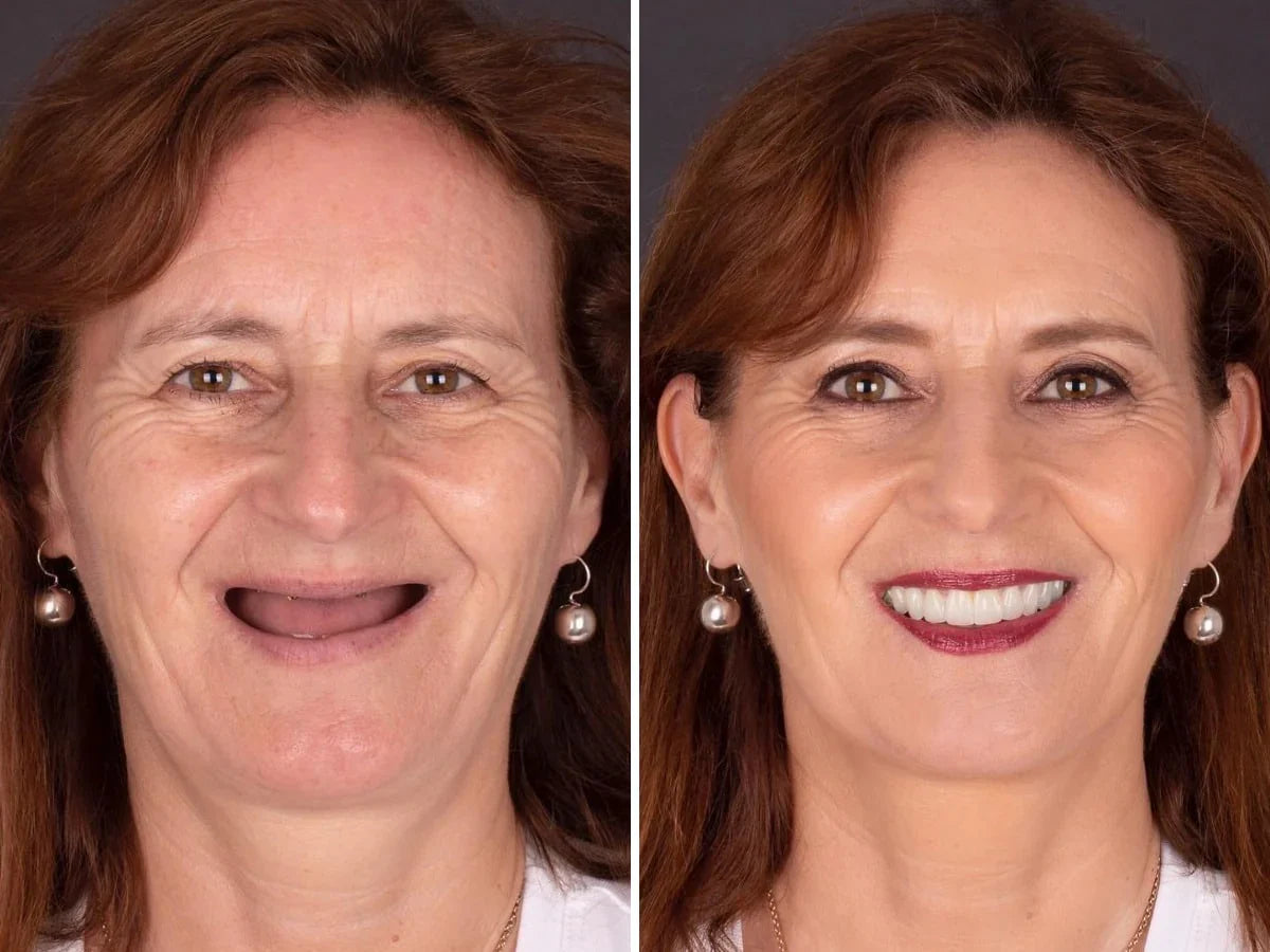 SmileFitPro® BioFusion Dentures🦷Suitable for all mouth shapes, perfect fit🦷
