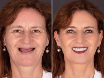 SmileFitPro® BioFusion Dentures🦷Suitable for all mouth shapes, perfect fit🦷