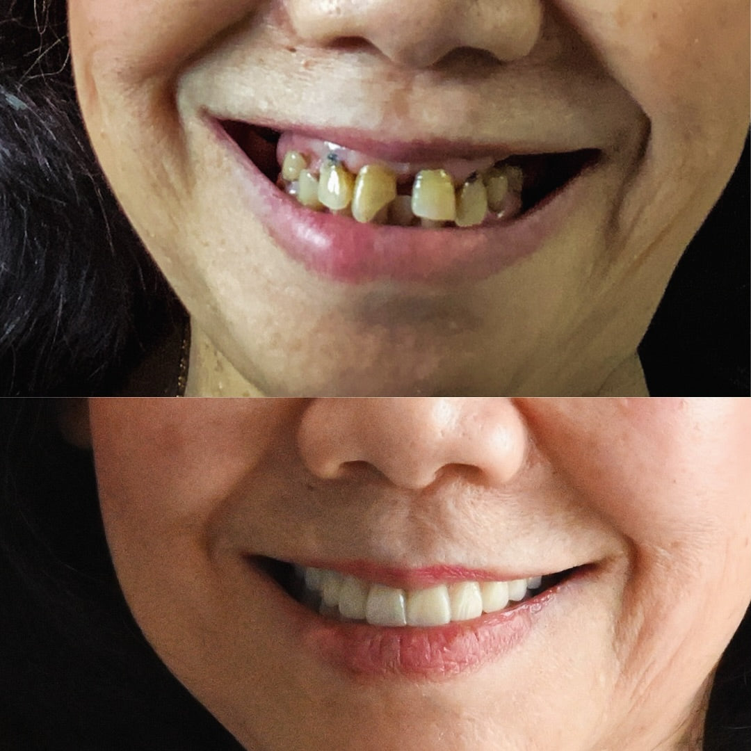 SmileFitPro® BioFusion Dentures🦷Suitable for all mouth shapes, perfect fit🦷