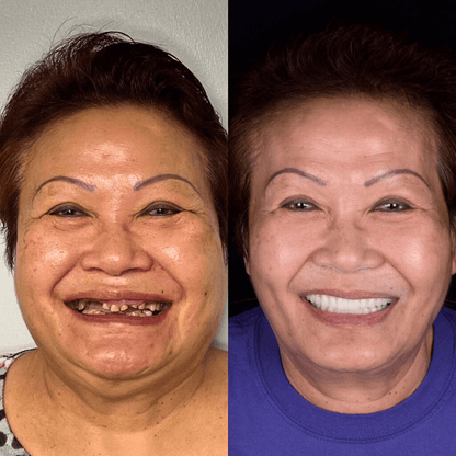 SmileFitPro® BioFusion Dentures🦷Suitable for all mouth shapes, perfect fit🦷