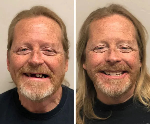 SmileFitPro® BioFusion Dentures🦷Suitable for all mouth shapes, perfect fit🦷