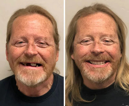 SmileFitPro® BioFusion Dentures🦷Suitable for all mouth shapes, perfect fit🦷