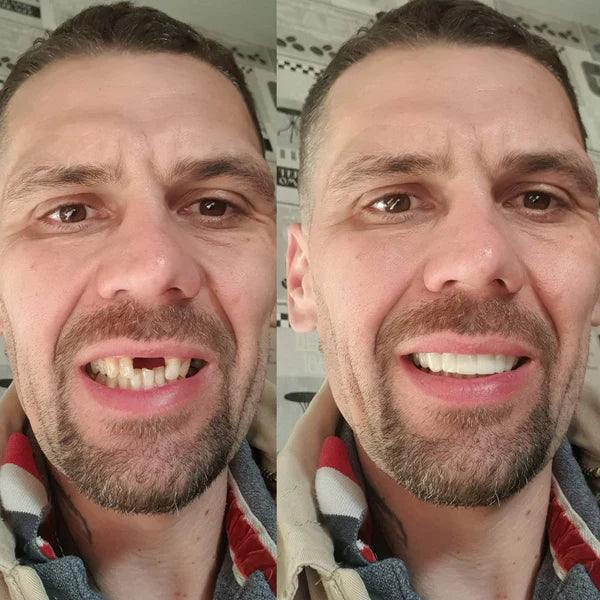 SmileFitPro® BioFusion Dentures🦷Suitable for all mouth shapes, perfect fit🦷